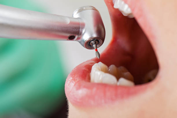 Best Emergency Root Canal Therapy in Guerneville, CA